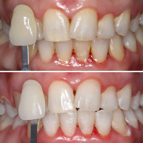 Before - After Template Invisalign-23