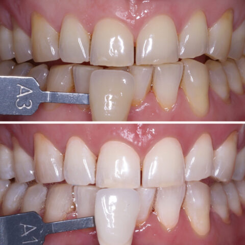 Before - After Template Invisalign