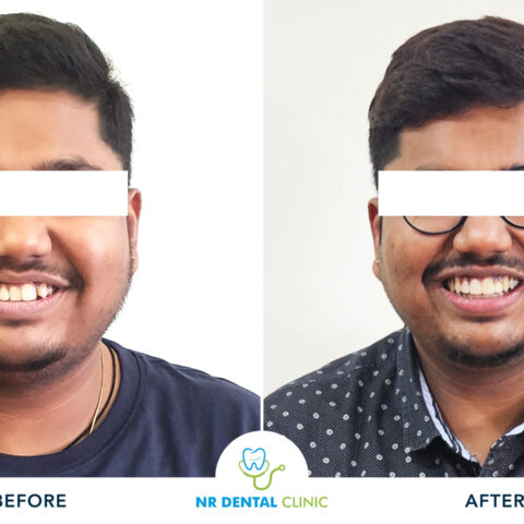 Braces - Before -After Template Invisalign-26