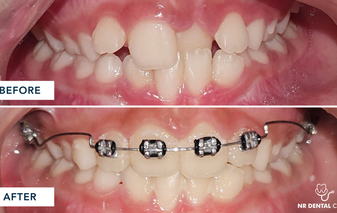 Dental Braces Treatment in Mumbai: Complete Guide to a Perfect Smile