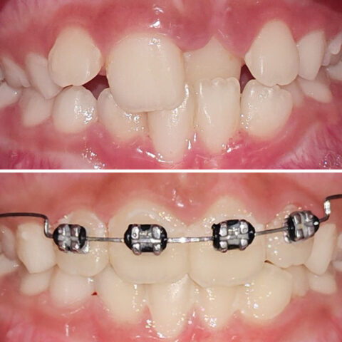 Braces - Before - After