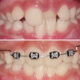 Dental Braces Treatment in Mumbai: Complete Guide to a Perfect Smile