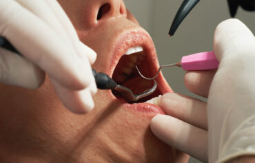 Dental Fillings