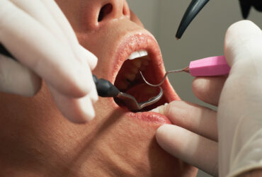 Dental Fillings