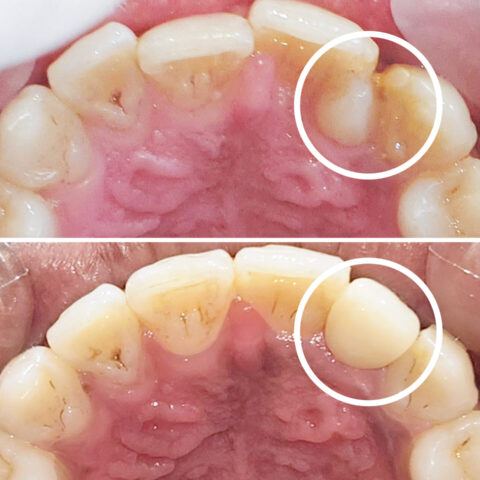 Implant - Before -After