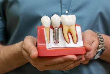 Dental Implants