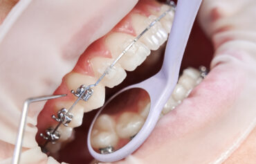 Orthodontics (Dental Braces)