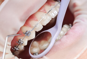 Orthodontics (Dental Braces)