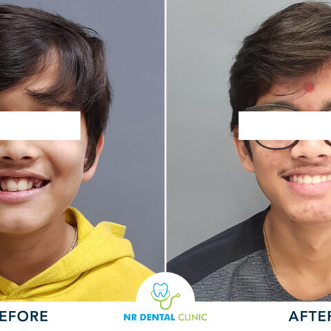 Before - After Orthodontics -15