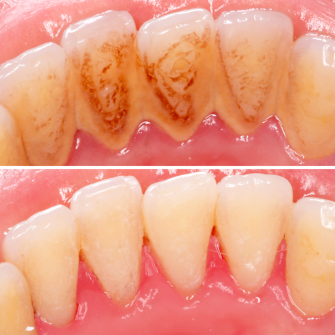 Before - After Teeth Cleaning -07