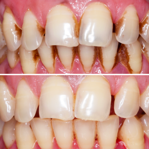 Before - After Teeth Cleaning-08