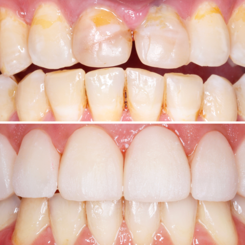 Before - After Veneers -06