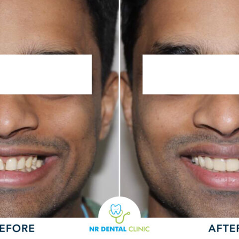 Before - After Veneers -10