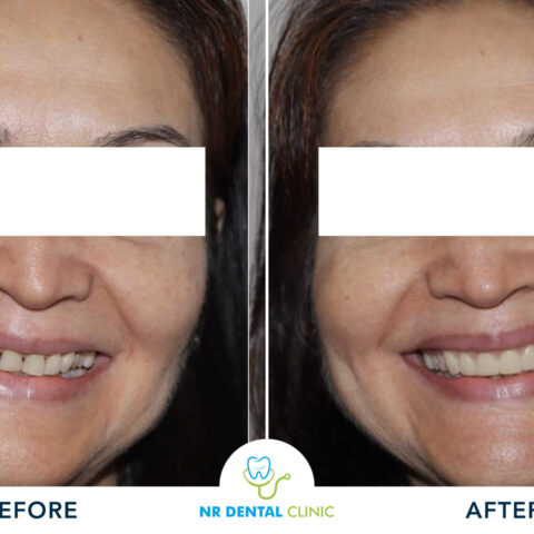 Before - After Veneers -14