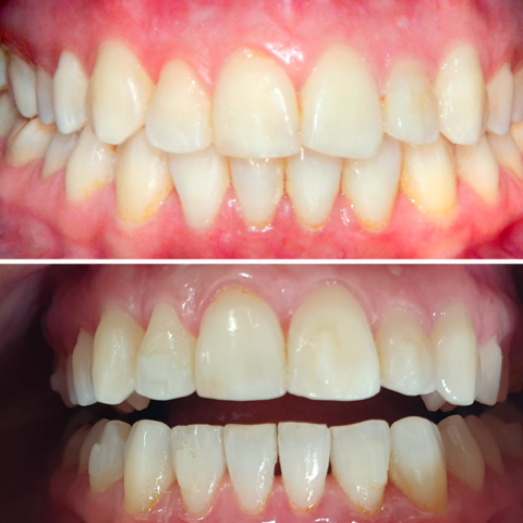 Before - After Invisalign-01