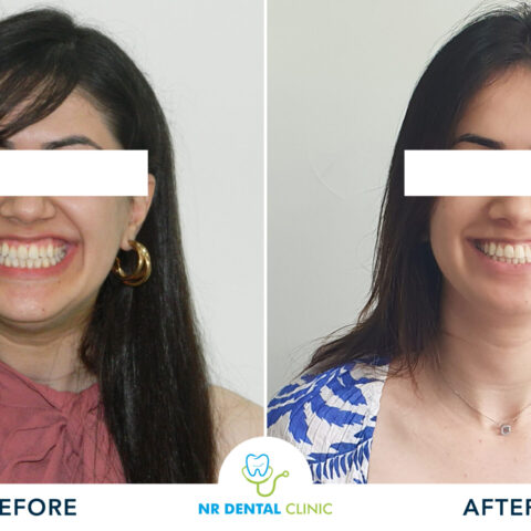 Before - After Invisalign-20