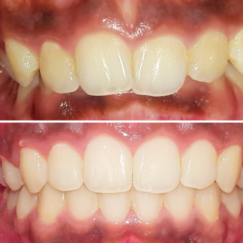 Before - After Orthodontics-02