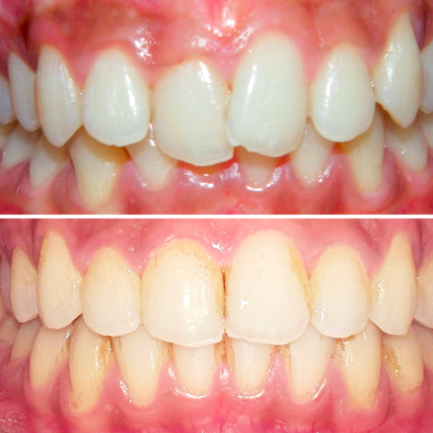 Before - After Orthodontics-04