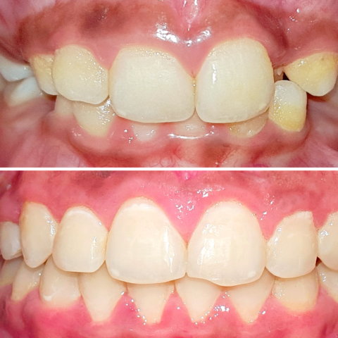 Before - After Orthodontics-11