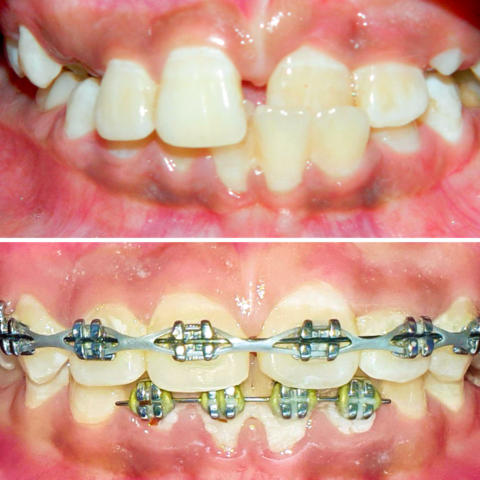 Before - After Orthodontics-13