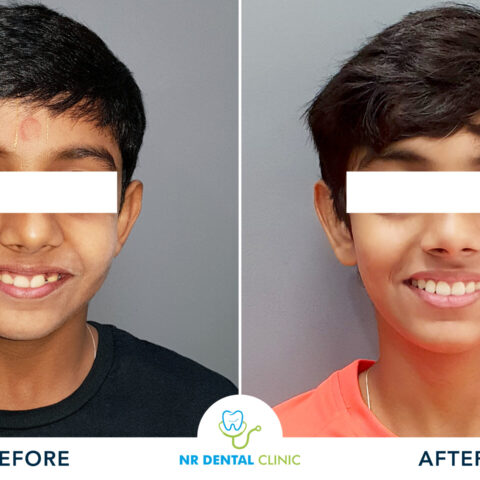 Before - After Orthodontics-16