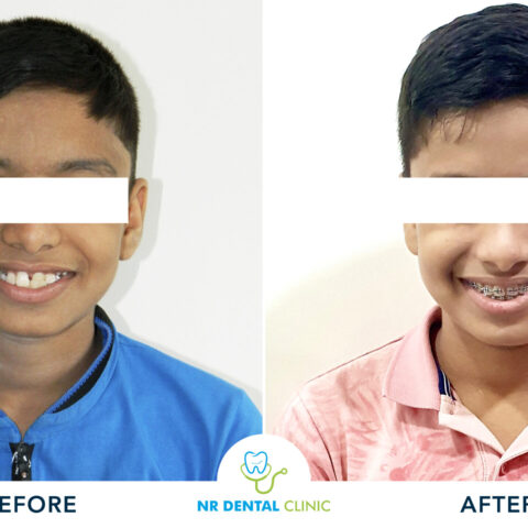 Before - After Orthodontics-17