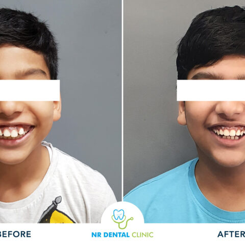 Before - After Orthodontics-19