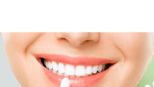 What Are Clear Aligners?