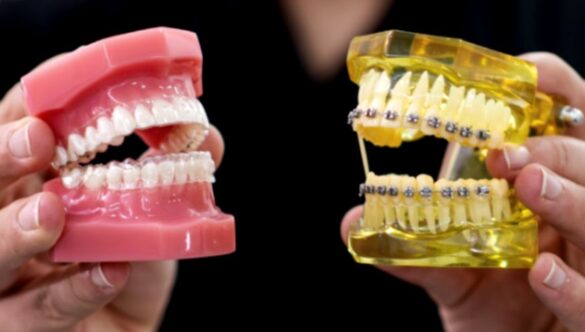 Invisalign vs Traditional Braces: The Ultimate Guide