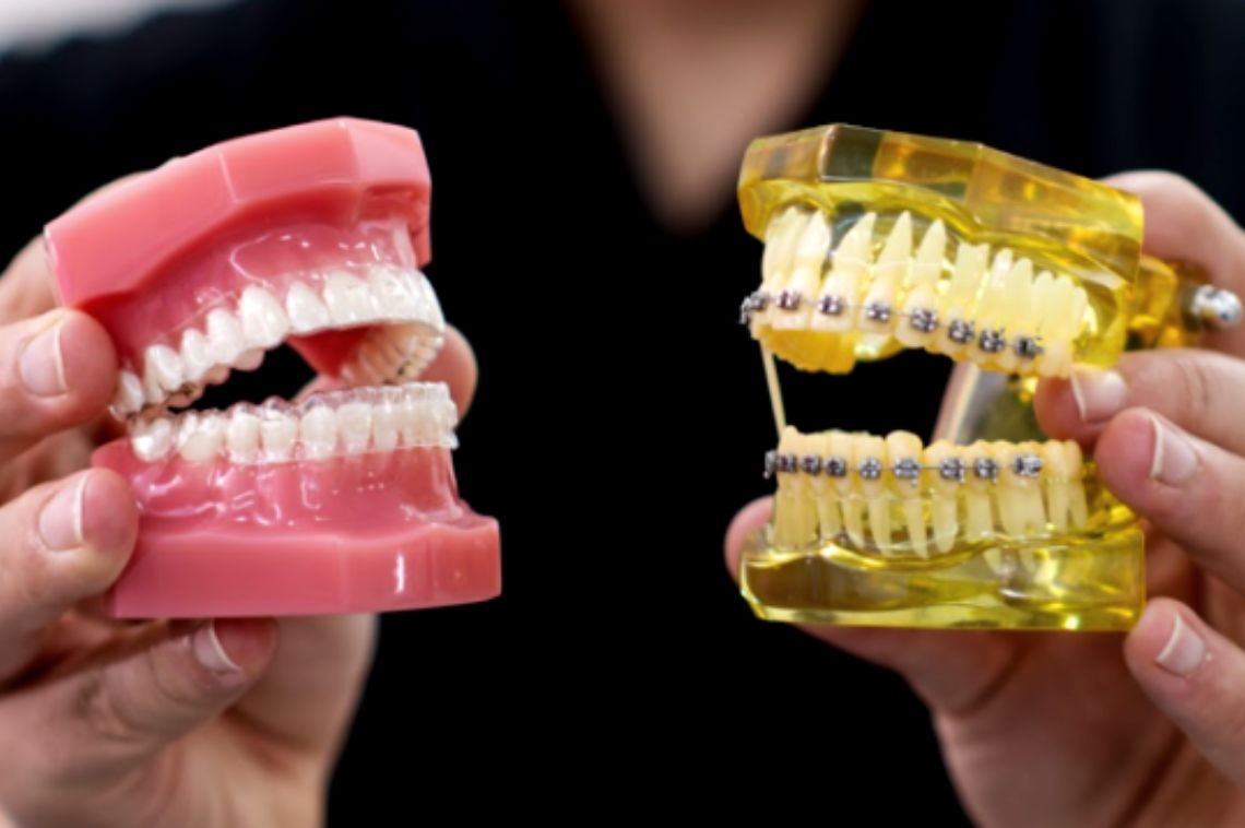 Invisalign vs Traditional Braces: The Ultimate Guide