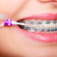 How Braces Straighten Children and Adult Teeth