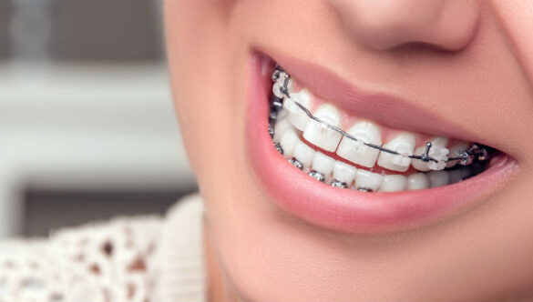 Damon Braces: How Do They Compare to Other Appliances for Straightening Teeth?