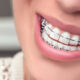 Damon Braces: How Do They Compare to Other Appliances for Straightening Teeth?