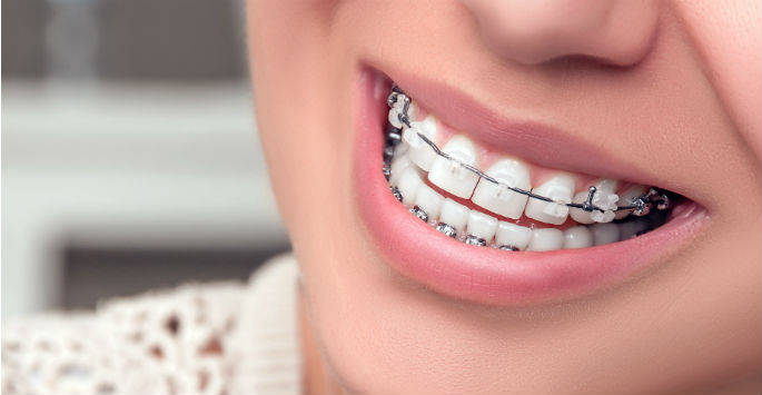 Damon Braces: How Do They Compare to Other Appliances for Straightening Teeth?