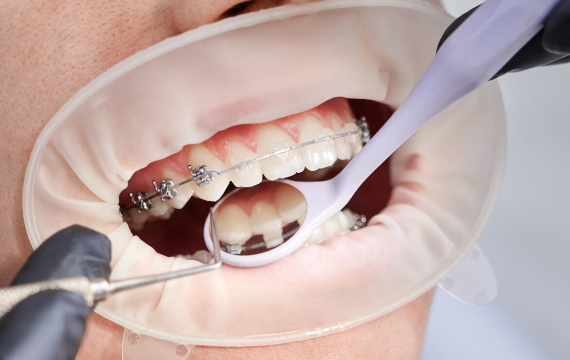 Metal Braces vs. Ceramic Braces