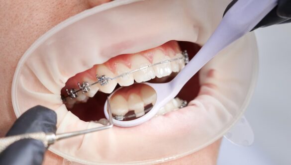 Metal Braces vs. Ceramic Braces