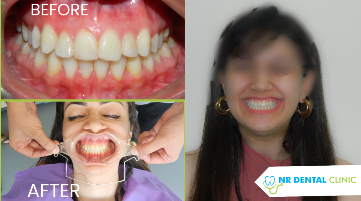 Orthodontic Treatment Before and After Results
