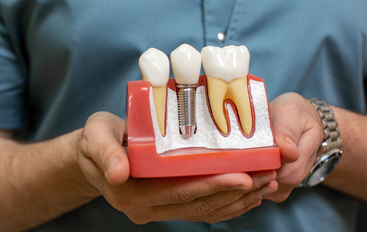 Dental Implants in Mumbai