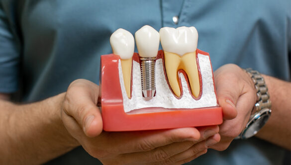 Dental Implants in Mumbai