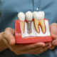 Dental Implants in Mumbai