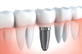 Dental Implants in Mumbai: Procedure, Cost & Recovery